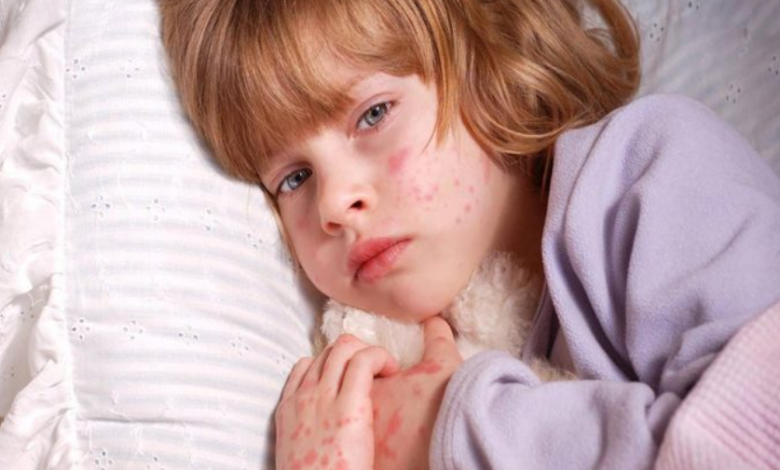 علل آبسه پوستی در کودکان و راه های درمان آن/ love magazine