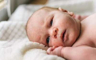 درمان آکنه نوزاد و راه های پیشگیری از آن/ love magazine