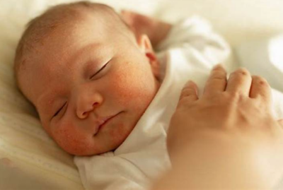 درمان آکنه نوزاد و راه های پیشگیری از آن/ love magazine